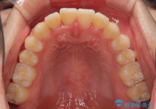 軽微なデコボコを安価に インビザライン・ライトによる矯正治療の治療後