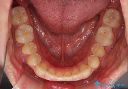 軽微なデコボコを安価に インビザライン・ライトによる矯正治療の治療後