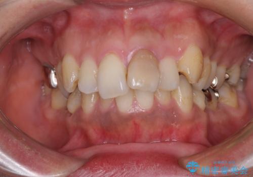 内側に倒れた前歯と口元の突出感　ワイヤー装置での抜歯矯正の症例 治療前