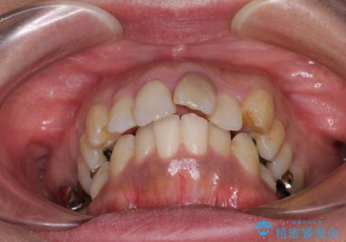 内側に倒れた前歯と口元の突出感 ワイヤー装置での抜歯矯正の治療前