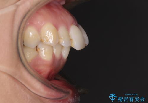 内側に倒れた前歯と口元の突出感 ワイヤー装置での抜歯矯正の治療前