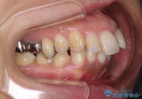 内側に倒れた前歯と口元の突出感　ワイヤー装置での抜歯矯正の治療前