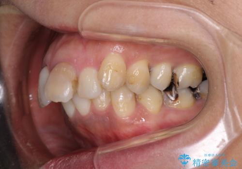 内側に倒れた前歯と口元の突出感 ワイヤー装置での抜歯矯正の治療前