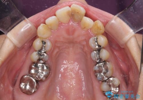 内側に倒れた前歯と口元の突出感　ワイヤー装置での抜歯矯正の治療前