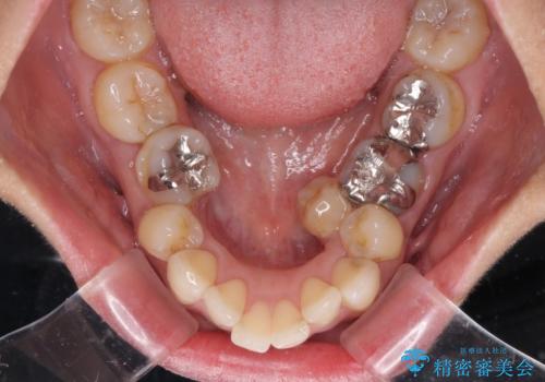 内側に倒れた前歯と口元の突出感 ワイヤー装置での抜歯矯正の治療前