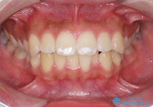 [ マウスピース矯正 ]  前歯の出っ歯感を改善したいの症例 治療前