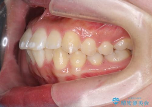 [ マウスピース矯正 ]  前歯の出っ歯感を改善したいの治療前