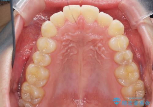 [ マウスピース矯正 ]  前歯の出っ歯感を改善したいの治療前