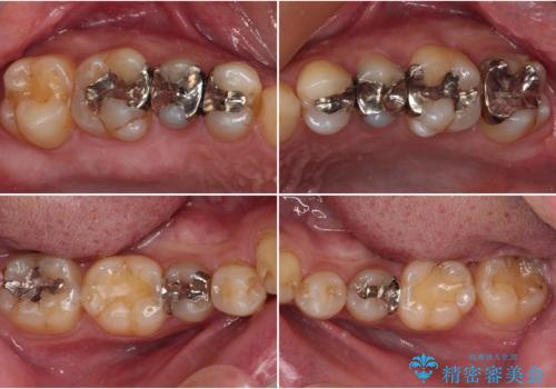オープンバイトと目立つ銀歯 インビザライン矯正とセラミック修復治療の治療前