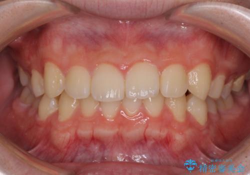 【モニター】斜めに突き出した前歯をインビザラインで改善の症例 治療前
