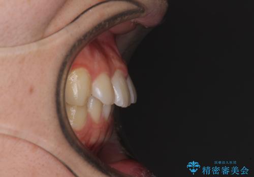 【モニター】斜めに突き出した前歯をインビザラインで改善の治療前