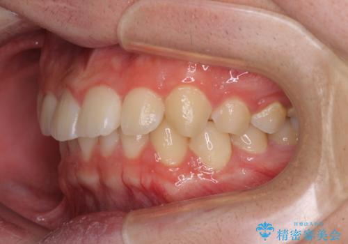 【モニター】斜めに突き出した前歯をインビザラインで改善の治療前