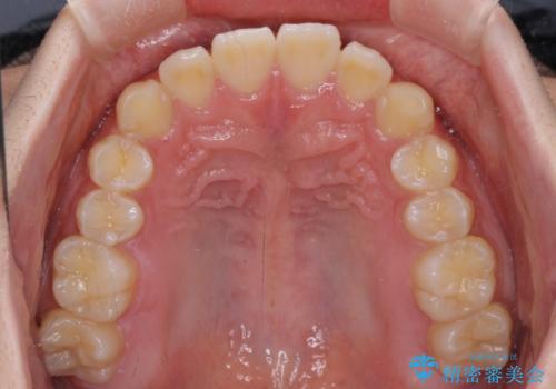 【モニター】斜めに突き出した前歯をインビザラインで改善の治療前