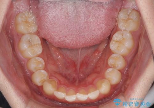 【モニター】斜めに突き出した前歯をインビザラインで改善の治療前