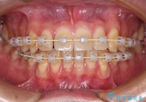ワイヤー装置での上下前歯の部分矯正の治療中