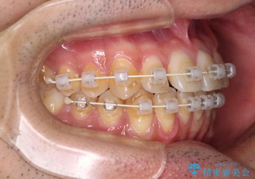 ワイヤー装置での上下前歯の部分矯正の治療中