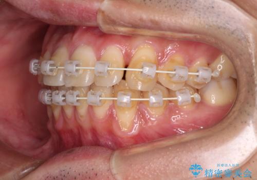 ワイヤー装置での上下前歯の部分矯正の治療中