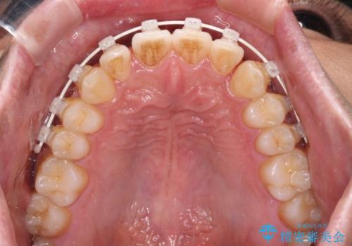 ワイヤー装置での上下前歯の部分矯正の治療中