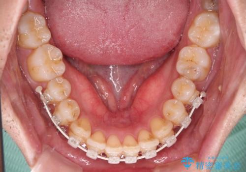 ワイヤー装置での上下前歯の部分矯正の治療中