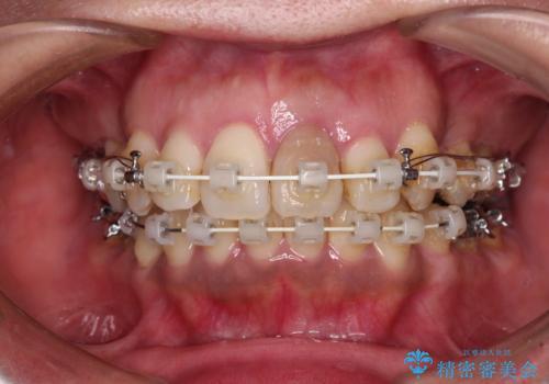 内側に倒れた前歯と口元の突出感 ワイヤー装置での抜歯矯正の治療中
