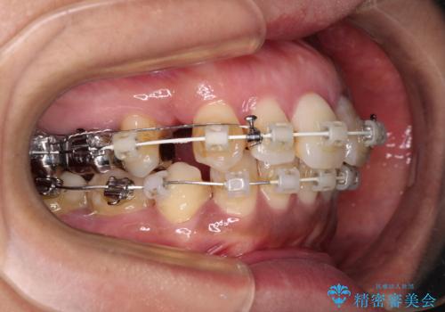 内側に倒れた前歯と口元の突出感　ワイヤー装置での抜歯矯正の治療中