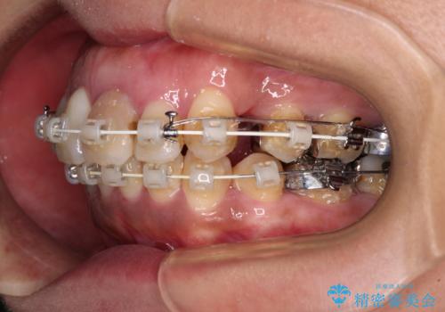 内側に倒れた前歯と口元の突出感 ワイヤー装置での抜歯矯正の治療中