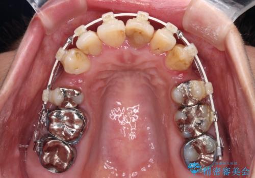 内側に倒れた前歯と口元の突出感 ワイヤー装置での抜歯矯正の治療中