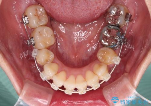 内側に倒れた前歯と口元の突出感　ワイヤー装置での抜歯矯正の治療中