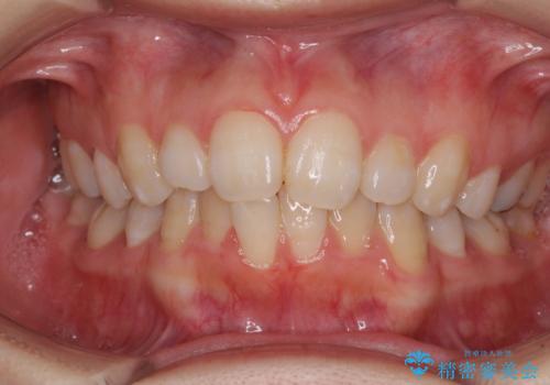 インビザライン・ライトで抜歯矯正の後戻りを解消の症例 治療前