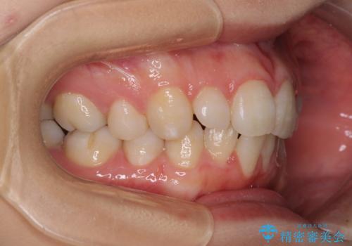 インビザライン・ライトで抜歯矯正の後戻りを解消の治療前