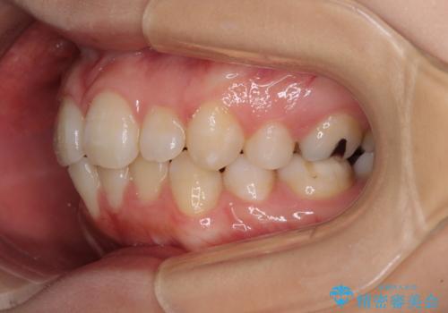 インビザライン・ライトで抜歯矯正の後戻りを解消の治療前