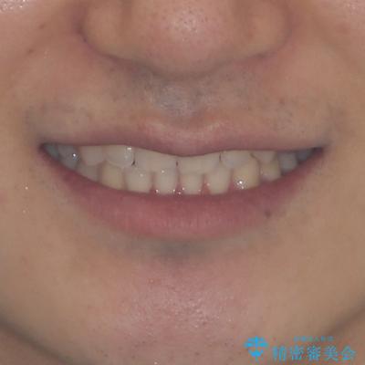 著しいディープバイトと隙間だらけの歯列 の治療後(顔貌)