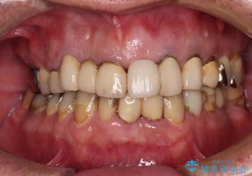 転倒で折れてしまった前歯 インプラントによるオールセラミックブリッジ治療の治療前