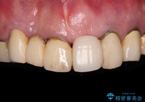 前歯インプラントの症例 治療前