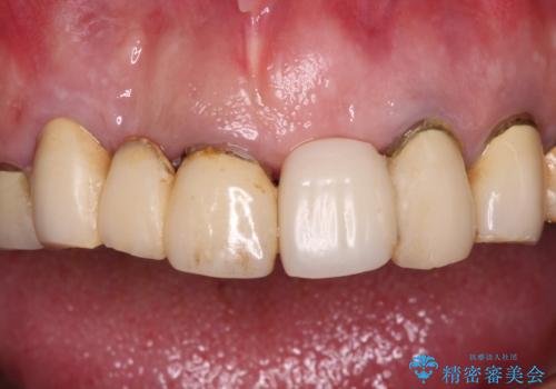 転倒で折れてしまった前歯 インプラントによるオールセラミックブリッジ治療の治療前