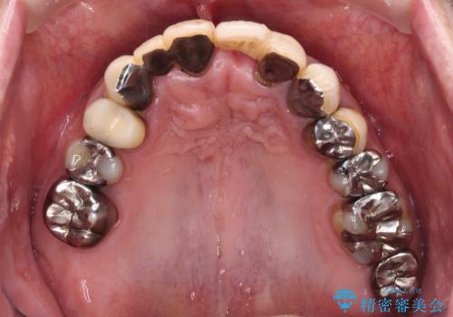 転倒で折れてしまった前歯 インプラントによるオールセラミックブリッジ治療の治療前