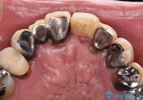 転倒で折れてしまった前歯 インプラントによるオールセラミックブリッジ治療の治療前