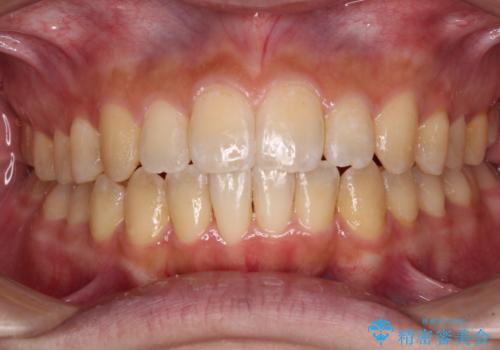 オープンバイトと目立つ銀歯 インビザライン矯正とセラミック修復治療の症例 治療後