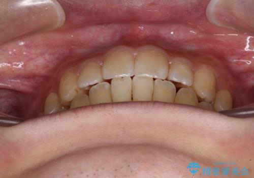 オープンバイトと目立つ銀歯 インビザライン矯正とセラミック修復治療の治療後