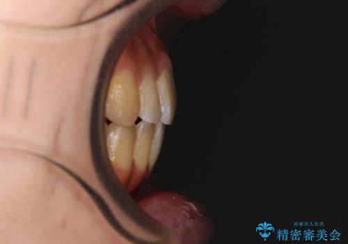 オープンバイトと目立つ銀歯 インビザライン矯正とセラミック修復治療の治療後