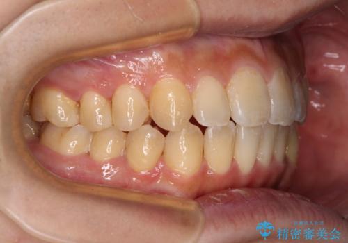オープンバイトと目立つ銀歯 インビザライン矯正とセラミック修復治療の治療後