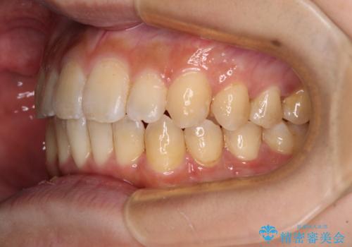 オープンバイトと目立つ銀歯 インビザライン矯正とセラミック修復治療の治療後