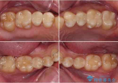 オープンバイトと目立つ銀歯 インビザライン矯正とセラミック修復治療の治療後