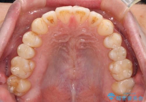 オープンバイトと目立つ銀歯 インビザライン矯正とセラミック修復治療の治療後