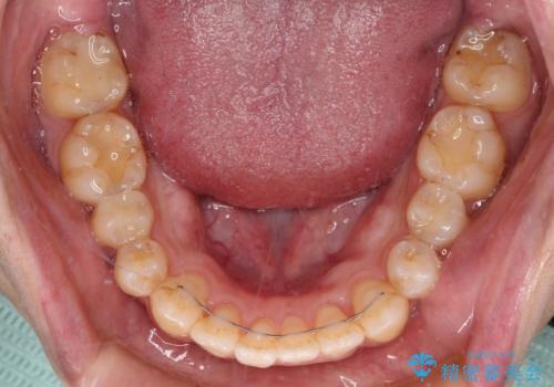 オープンバイトと目立つ銀歯 インビザライン矯正とセラミック修復治療の治療後