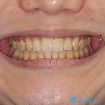 オープンバイトと目立つ銀歯　インビザライン矯正とセラミック修復治療の治療後（顔貌）