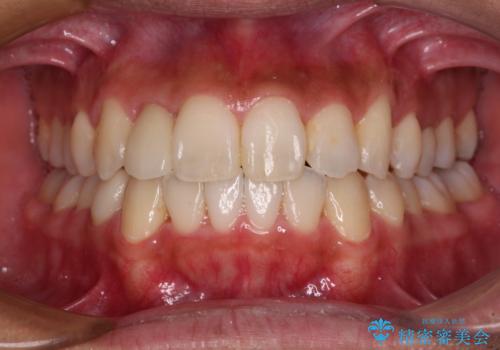 【モニター】左右のクロスバイトをインビザラインできれいに改善の症例 治療後