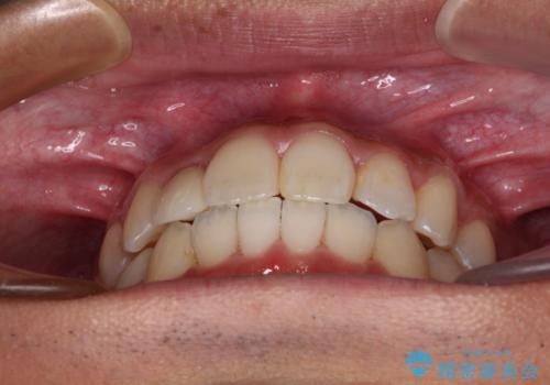 【モニター】左右のクロスバイトをインビザラインできれいに改善の治療後