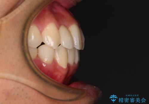 【モニター】左右のクロスバイトをインビザラインできれいに改善の治療後