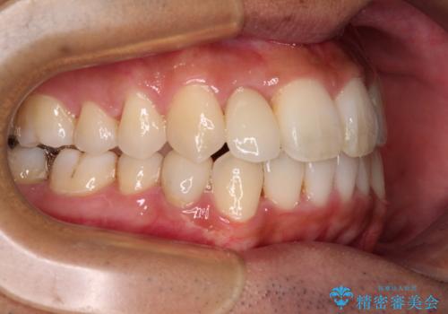【モニター】左右のクロスバイトをインビザラインできれいに改善の治療後